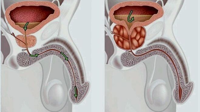 próstata sa e inflamada con prostatite