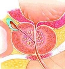 Prostate -Denoma